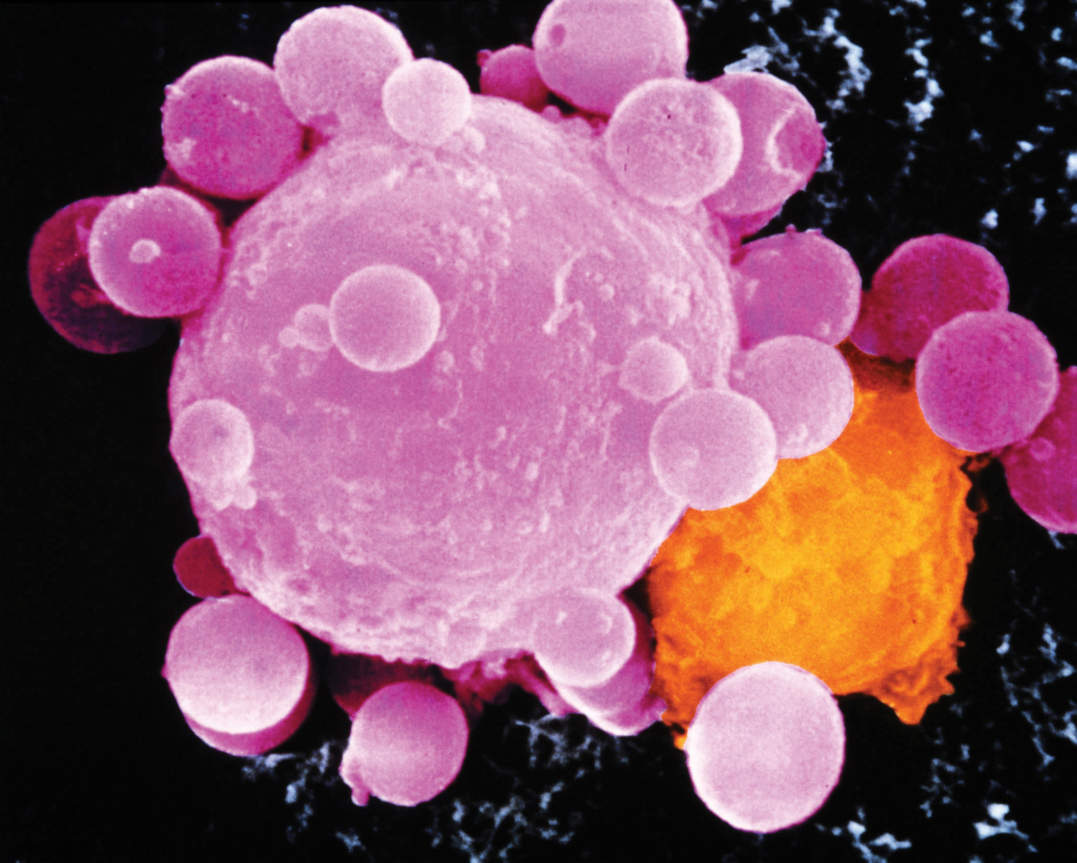 Cancer cell death. Colored SEM of lymphocyte attacking cancer cell.