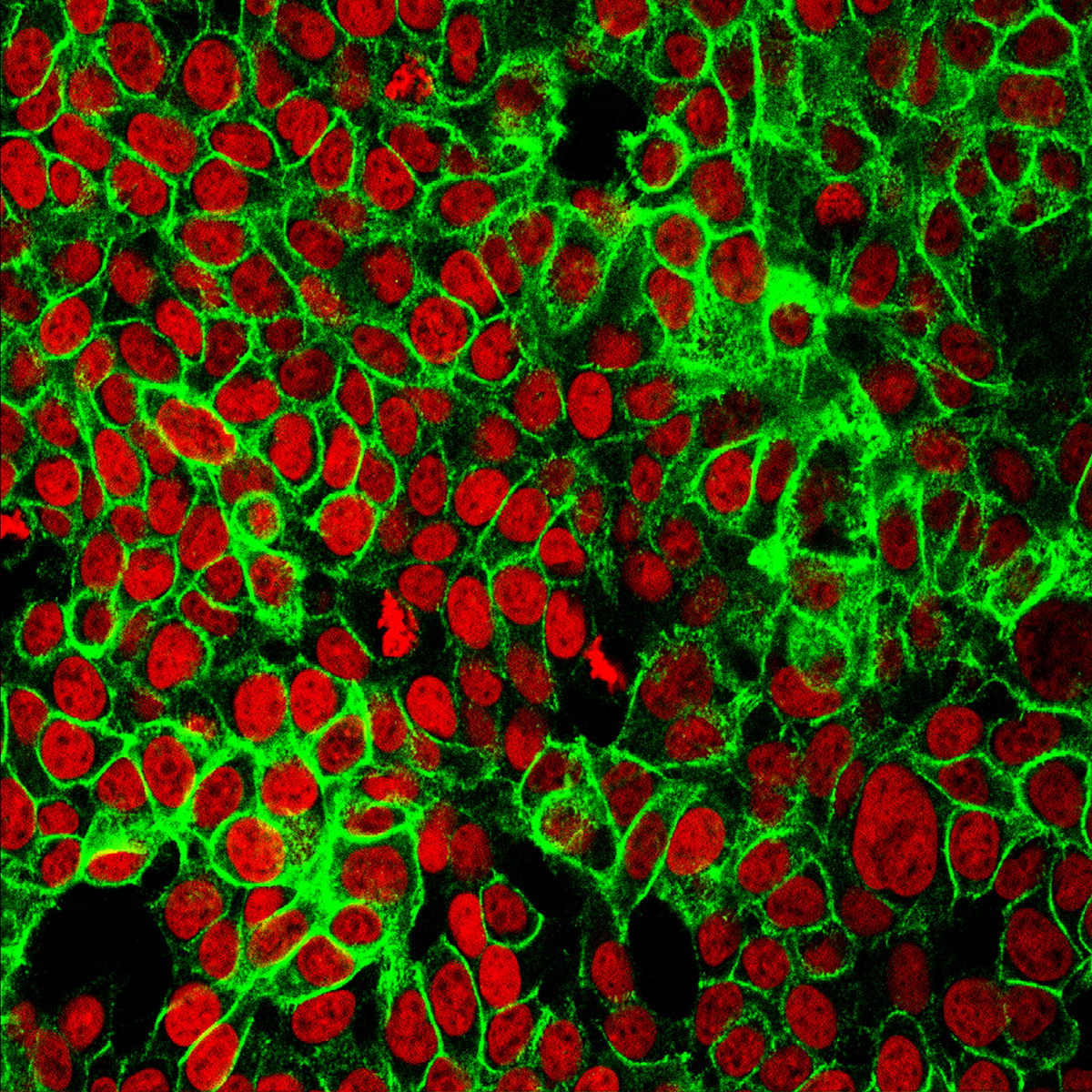 Human colon cancer cells with the cell nuclei stained red and the protein E-cadherin stained green.