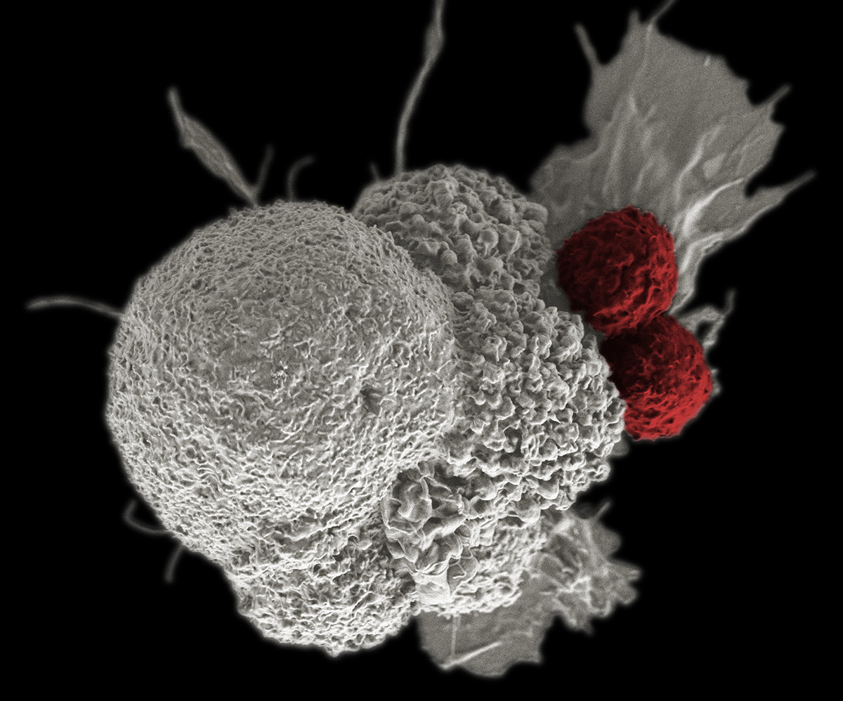 Scanning electron micrograph of an oral squamous cancer cell (white) being attacked by two cytotoxic T cells (red), part of a natural immune response.