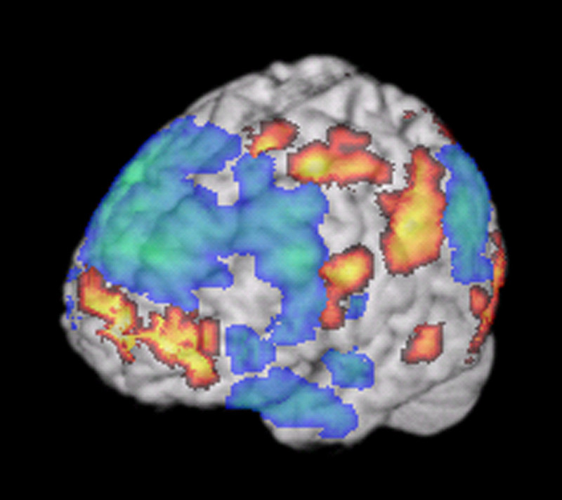 Brain image from a functional MRI scan when a person was listening to improvised jazz music.