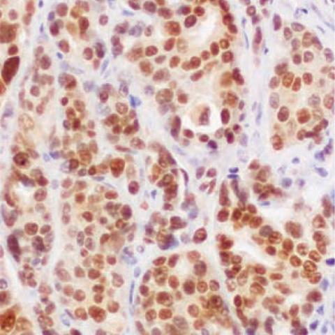 Immunohistochemical staining of a human brain metastasis