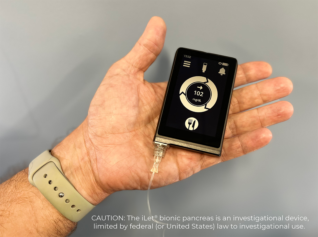 Hand holding the iLet bionic pancreas device