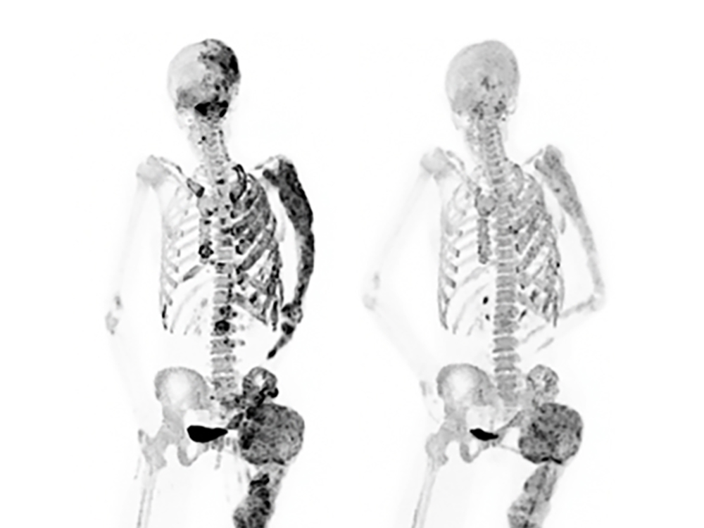 Before and after bone scans