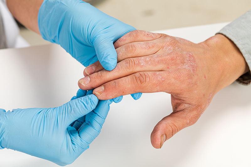Dermatologist wearing gloves examines the skin of a patient with eczema Dermatologist wearing gloves examines the skin of a patient with eczema