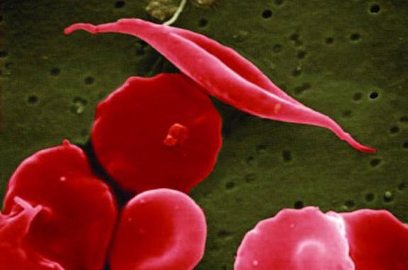 Magnified red blood cells and sickled cells.