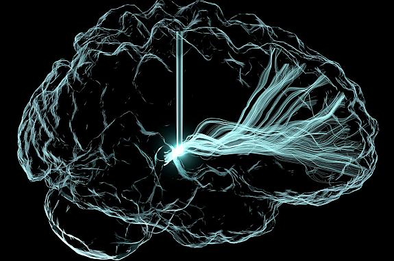 Artistic rendering of deep brain stimulation (DBS), with an outline of brain and vertical lines that represent wire leads with a single electrode that has been inserted deep within the brain to reach a region involved in cognition, the central thalamus.