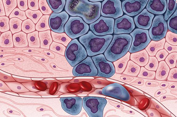 Growing cancer cells (in purple) are surrounded by healthy cells (in pink), illustrating a primary tumor spreading to other parts of the body through the circulatory system.