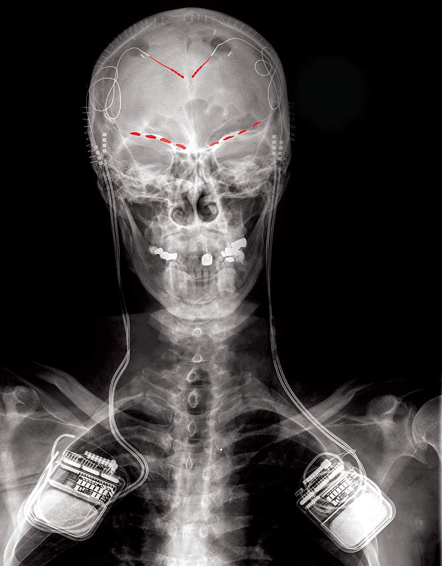 X-ray image of electrode brain implants X-ray image of electrode brain implants
