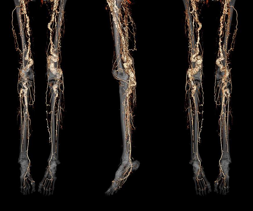 A CT angiography scan of a person with ACDC disease showing abnormal calcification of the blood vessels in the legs and feet. A CT angiography scan of a person with ACDC disease showing abnormal calcification of the blood vessels in the legs and feet.