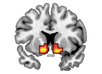 Brain image with 2 small red and yellow patches.