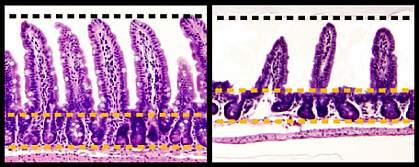 Microscopic images with healthy finger-like structures in top panel and blunted, damaged ones in bottom panel