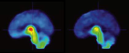 PET scan images of 2 human brains, with the top brain showing a patch of red at center