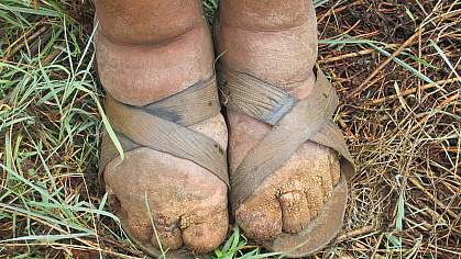 Abnormally swollen feet