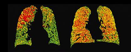 Lungs with green, yellow and red areas.