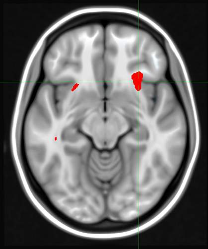 A brain scan showing red areas in the front half of the brain