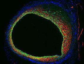 A narrowing blood vessel.