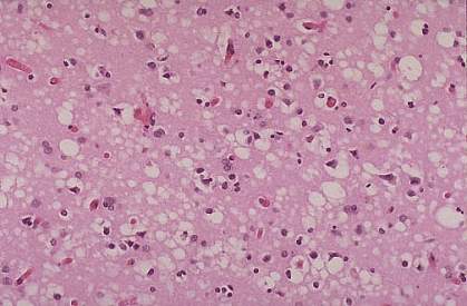 Brain tissue of a CJD patient