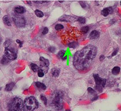 Nanoparticles in a mouse lung tumor.