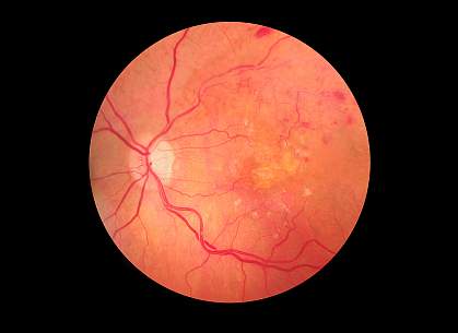 Medical photo of retinopathy