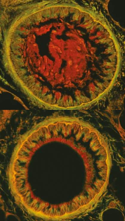 Cross sections show an untreated bronchial airway with mucus inside compared to a treated airway that is clear of mucus