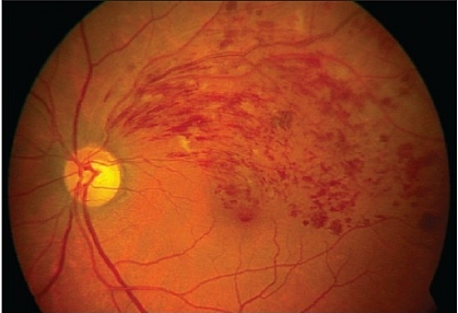 Eye with retinal vein occlusion Color fundus photograph of an eye with retinal vein occlusion