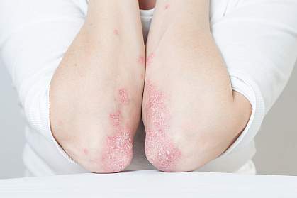 Flaky, red skin on person’s elbows Flaky, red skin on person’s elbows.