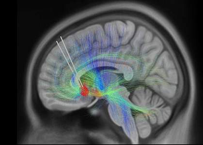 MRI scan of a brain with an implanted DBS device.