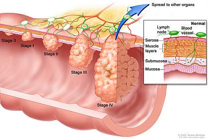 Illustration of colorectal cancer stages.
