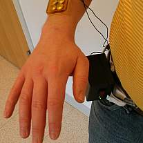 Healing Venous Ulcers.