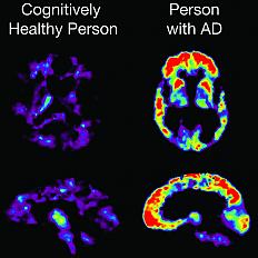 Amyloid imaging and other biomarker advances detect Alzheimer’s-related changes taking place in the living brain.