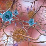 Beta-Amyloid Plaques and Tau in the Brain