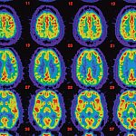 PET scans comparing an Alzheimer’s brain with healthy brain.