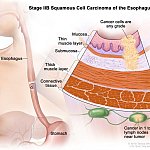 Anatomic illustration of stage 2b esophageal cancer, with pop out of cancer cells in nearby lymph nodes.