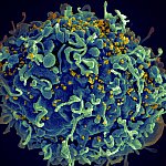 HIV, the AIDS virus (yellow), infecting a human immune cell