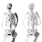 Before and after bone scans