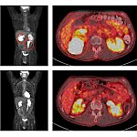 Image of medical scans that show shrinking tumors in a patient with large lymphoma tumors.