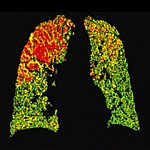 Lungs with green, yellow and red areas.