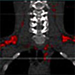 Brown fat in neck and upper back region.