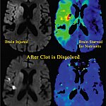 MRI images showing an ischemic stroke as it is happening and as it recovers.